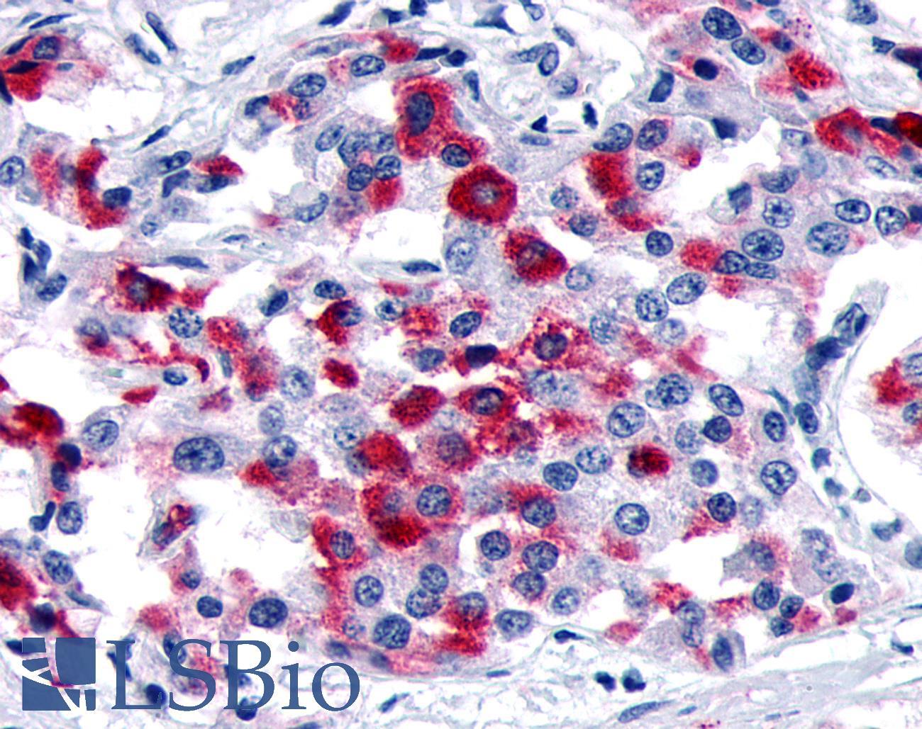 MC1R Antibody - Pancreas, carcinoma