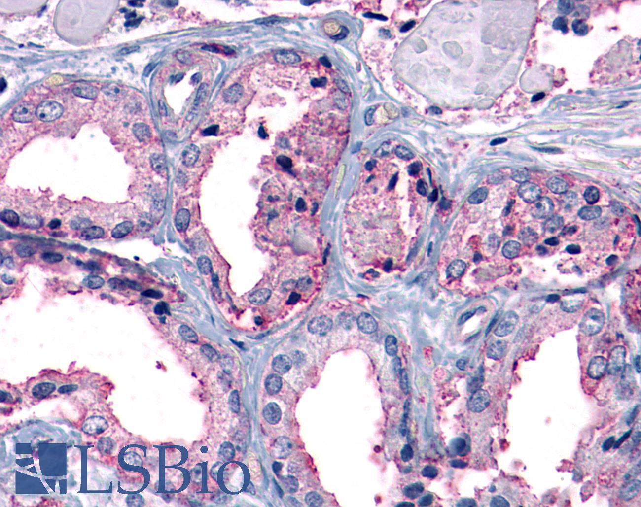 MC1R Antibody - Prostate, Carcinoma