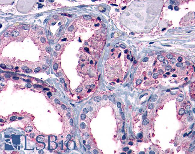 MC1R Antibody - Prostate, Carcinoma