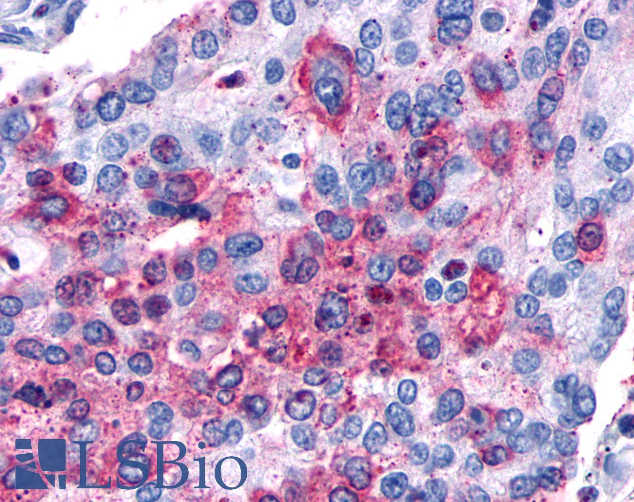 MC1R Antibody - Lung, Non Small-Cell Carcinoma