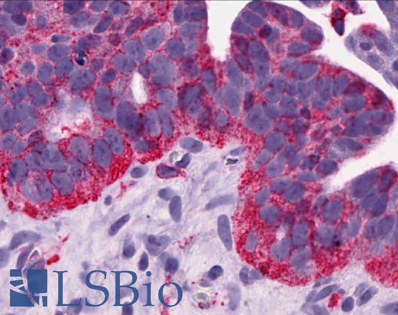 MCHR1 Antibody - Anti-MCHR1 antibody IHC of human Ovary, Carcinoma. Immunohistochemistry of formalin-fixed, paraffin-embedded tissue after heat-induced antigen retrieval.