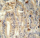 MEP1A / Meprin Alpha Antibody - MEP1A antibody immunohistochemistry of formalin-fixed and paraffin-embedded human colon carcinoma followed by peroxidase-conjugated secondary antibody and DAB staining.