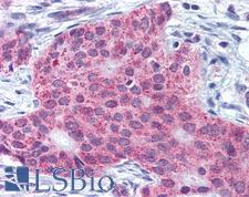 MMP13 Antibody - Anti-MMP13 antibody IHC of human breast carcinoma. Immunohistochemistry of formalin-fixed, paraffin-embedded tissue after heat-induced antigen retrieval.