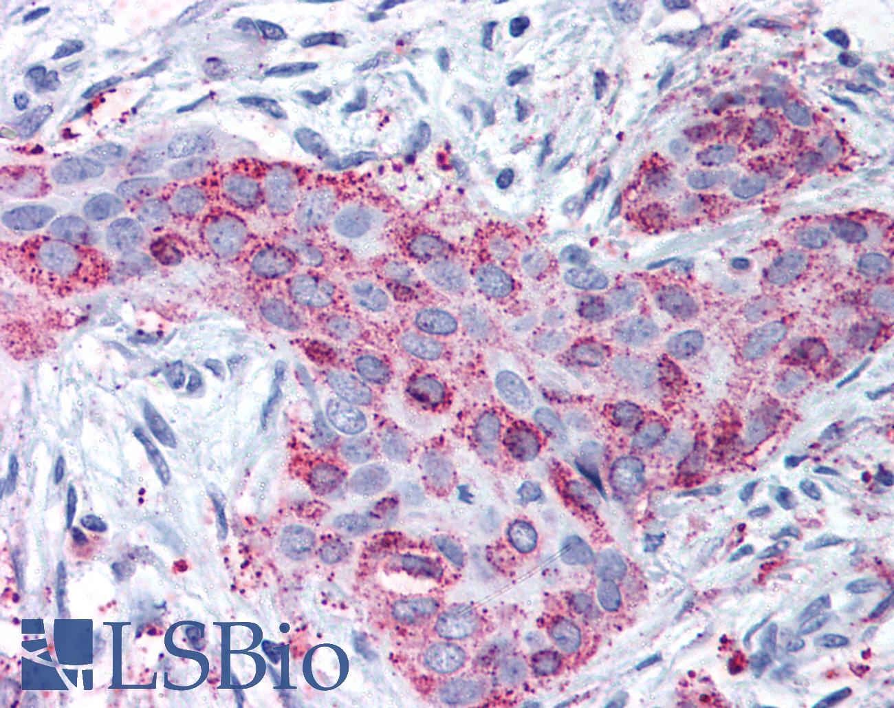 MMP13 Antibody - Anti-MMP13 antibody IHC of human breast carcinoma. Immunohistochemistry of formalin-fixed, paraffin-embedded tissue after heat-induced antigen retrieval.