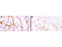 MSLN / Mesothelin Antibody - Anti-Mesothelin Antibodies - Immunohistochemistry. Immunohistochemistry using anti-mesothelin antibodies to detect mesothelin in PEFF human tissue sections treated by antigen retrieval methods. Anti-mesothelin primary antibodies were used to label these sections as follows: C, MAb MB; and D, MAb MN. Reprinted with permission fromClin. Cancer Res. 11(16):5840-6.