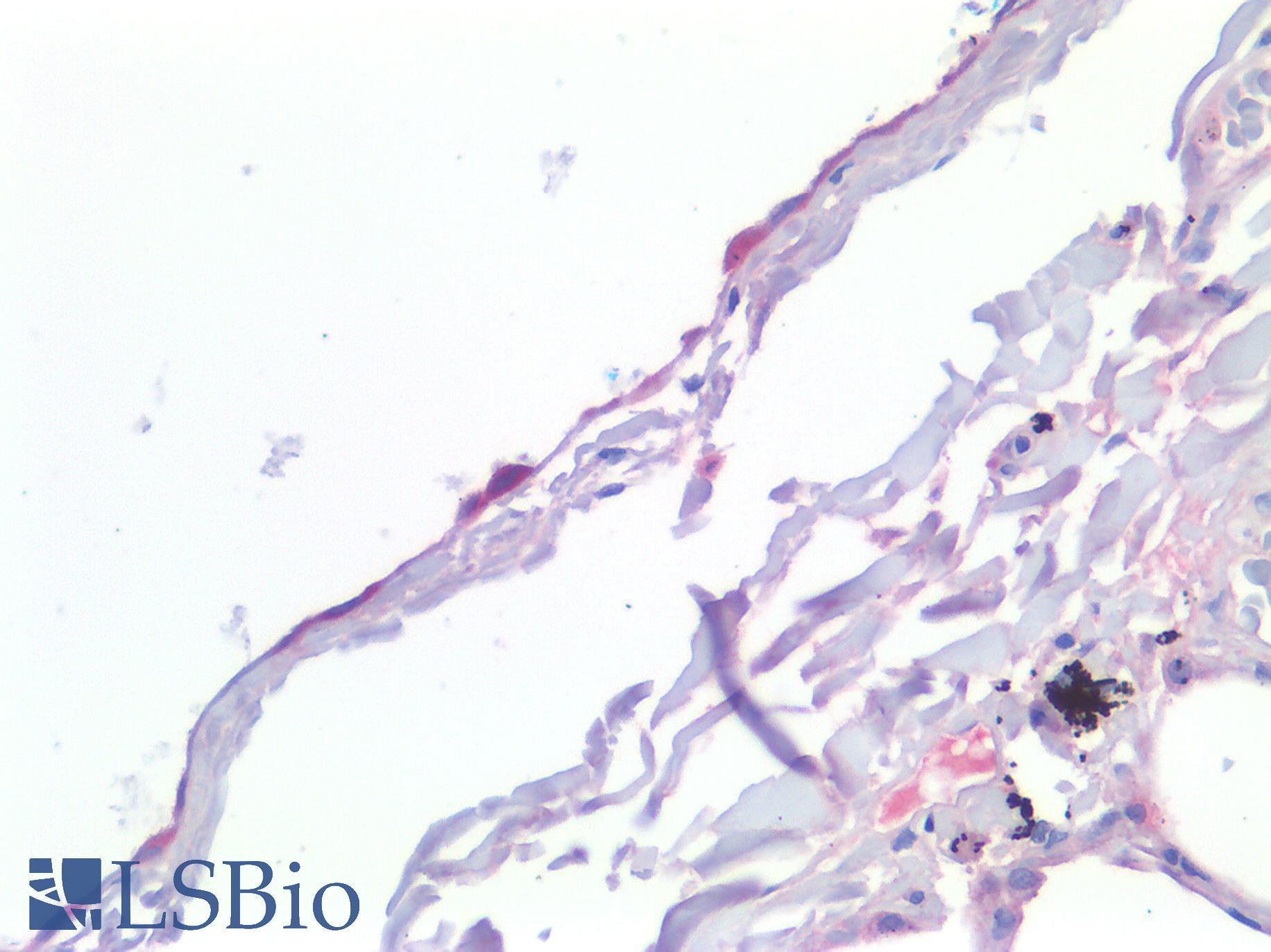 MSLN / Mesothelin Antibody - Human Lung: Formalin-Fixed, Paraffin-Embedded (FFPE)