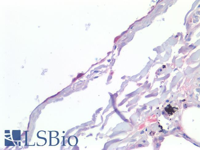 MSLN / Mesothelin Antibody - Human Lung: Formalin-Fixed, Paraffin-Embedded (FFPE)