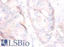 MSTN / GDF8 / Myostatin Antibody - Immunohistochemistry of paraffin-embedded human colorectal carcinoma using MSTN / GDF8 / Myostatin antibody at dilution of 1:50.  This image was taken for the unconjugated form of this product. Other forms have not been tested.