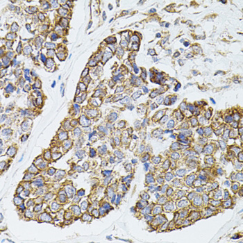 MTTP / MTP Antibody - Immunohistochemistry of paraffin-embedded mouse esophageal cancer tissue.