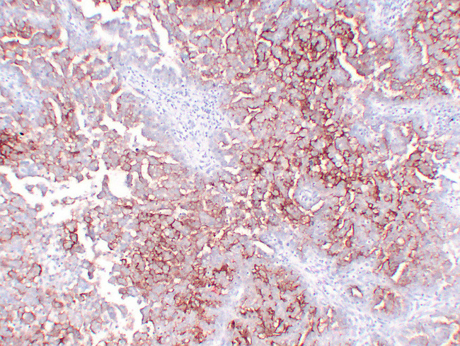 MUC16 / CA125 Antibody - Ovarian Serous Carcinoma 