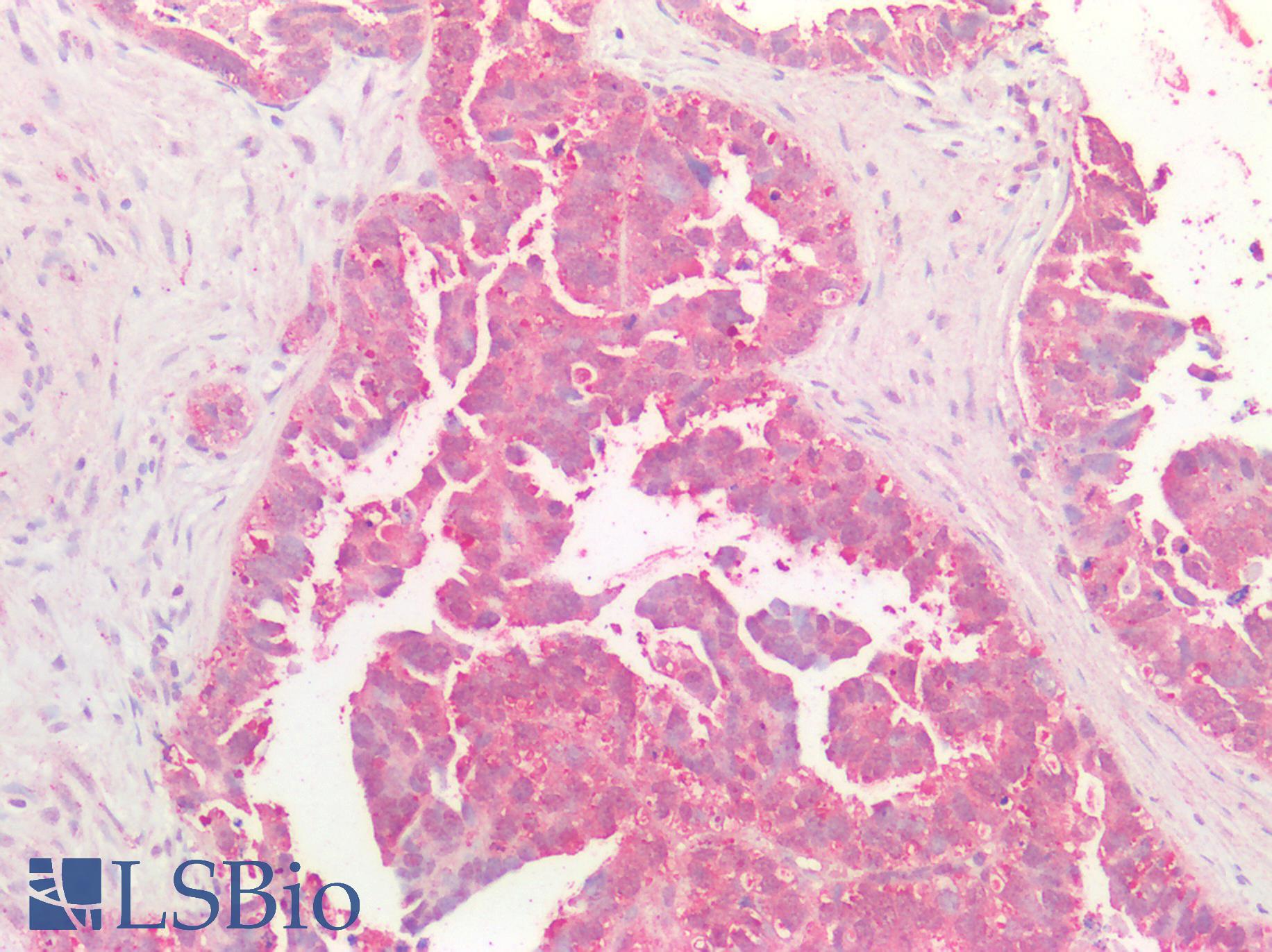 MYC / c-Myc Antibody - Human Ovarian Carcinoma: Formalin-Fixed, Paraffin-Embedded (FFPE)