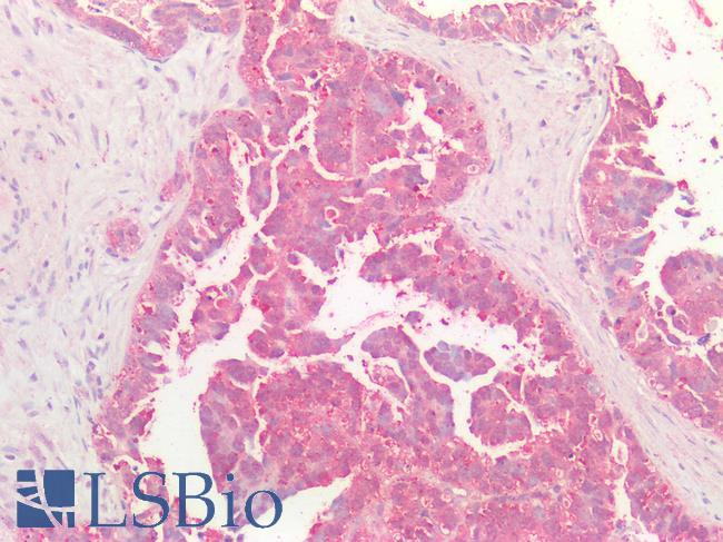 MYC / c-Myc Antibody - Human Ovarian Carcinoma: Formalin-Fixed, Paraffin-Embedded (FFPE)