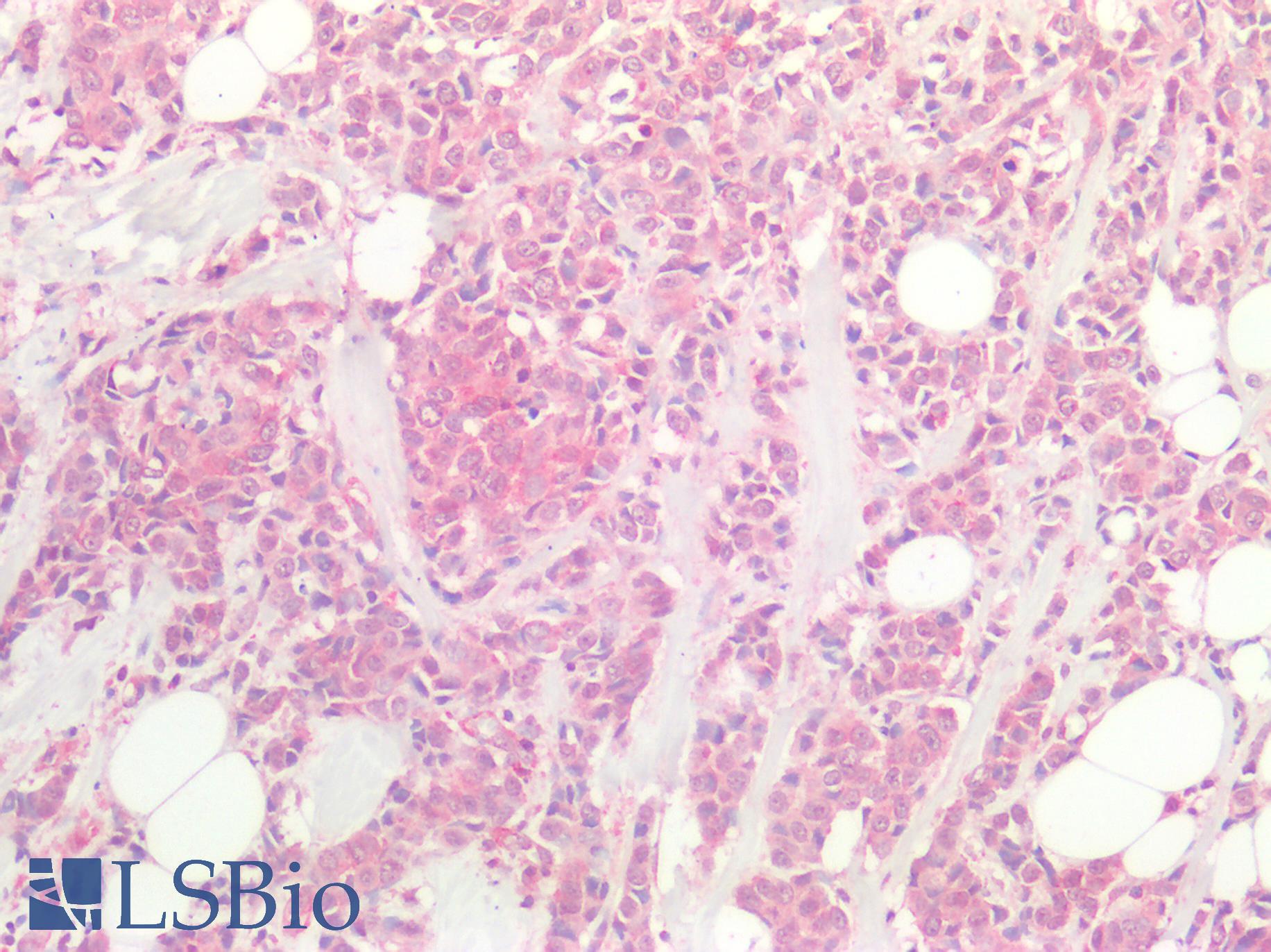 MYC / c-Myc Antibody - Human Breast Carcinoma: Formalin-Fixed, Paraffin-Embedded (FFPE)