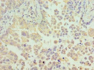 N6AMT1 Antibody - Immunohistochemistry of paraffin-embedded human lung cancer using antibody at 1:100 dilution.