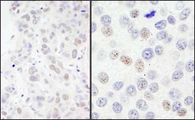 NBN / Nibrin Antibody - Detection of Human NBS1 by Immunohistochemistry. Sample: FFPE section of human breast carcinoma. Antibody: Affinity purified rabbit anti-NBS1 used at a dilution of 1:200 (1 Detection: DAB.