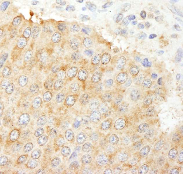 NF2 / Merlin Antibody - Detection of Human NF2 by Immunohistochemistry. Sample: FFPE section of human pancreatic islet cell tumor. Antibody: Affinity purified rabbit anti- NF2 used at a dilution of 1:1000 (1 Detection: DAB.