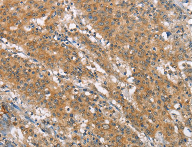 NLRP7 / NALP7 Antibody - Immunohistochemistry of paraffin-embedded Human thyroid cancer using NLRP7 Polyclonal Antibody at dilution of 1:40.