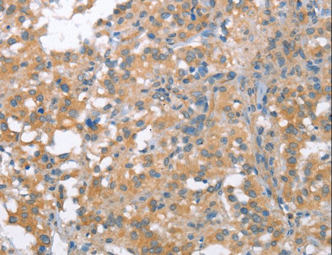 NLRP7 / NALP7 Antibody - Immunohistochemistry of paraffin-embedded Human thyroid cancer using NLRP7 Polyclonal Antibody at dilution of 1:40.