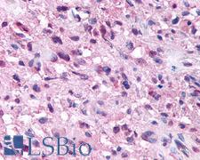 NPSR1 / NPSR / GPR154 Antibody - Anti-NPSR1 / NPSR / GPR154 antibody IHC of human Brain, Glioblastoma. Immunohistochemistry of formalin-fixed, paraffin-embedded tissue after heat-induced antigen retrieval.