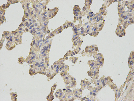 OGT / O-GLCNAC Antibody - Immunohistochemistry of paraffin-embedded human breast cancer using OGT antibody at dilution of 1:100 (200x lens).