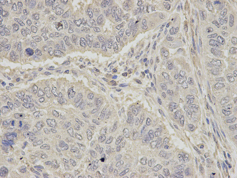 OGT / O-GLCNAC Antibody - Immunohistochemistry of paraffin-embedded human esophageal cancer using OGT antibody at dilution of 1:100 (200x lens).