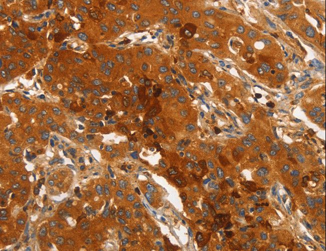 ORM2 / Orosomucoid 2 Antibody - Immunohistochemistry of paraffin-embedded Human lung cancer using ORM2 Polyclonal Antibody at dilution of 1:40.