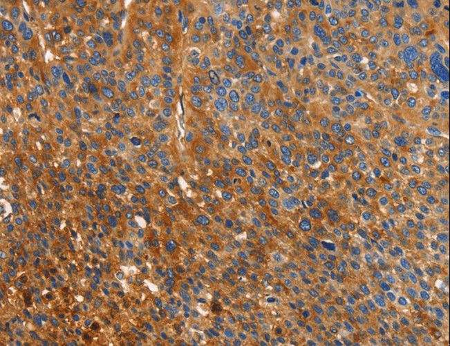 ORM2 / Orosomucoid 2 Antibody - Immunohistochemistry of paraffin-embedded Human liver cancer using ORM2 Polyclonal Antibody at dilution of 1:40.