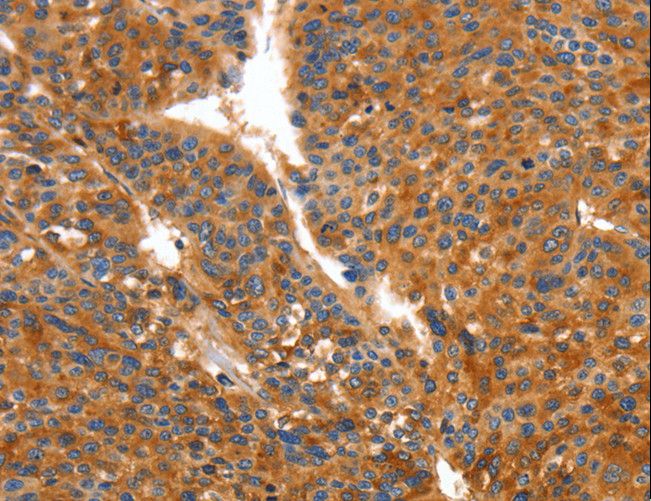 ORM2 / Orosomucoid 2 Antibody - Immunohistochemistry of paraffin-embedded Human liver cancer using ORM2 Polyclonal Antibody at dilution of 1:50.