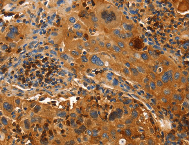 ORM2 / Orosomucoid 2 Antibody - Immunohistochemistry of paraffin-embedded Human lung cancer using ORM2 Polyclonal Antibody at dilution of 1:50.