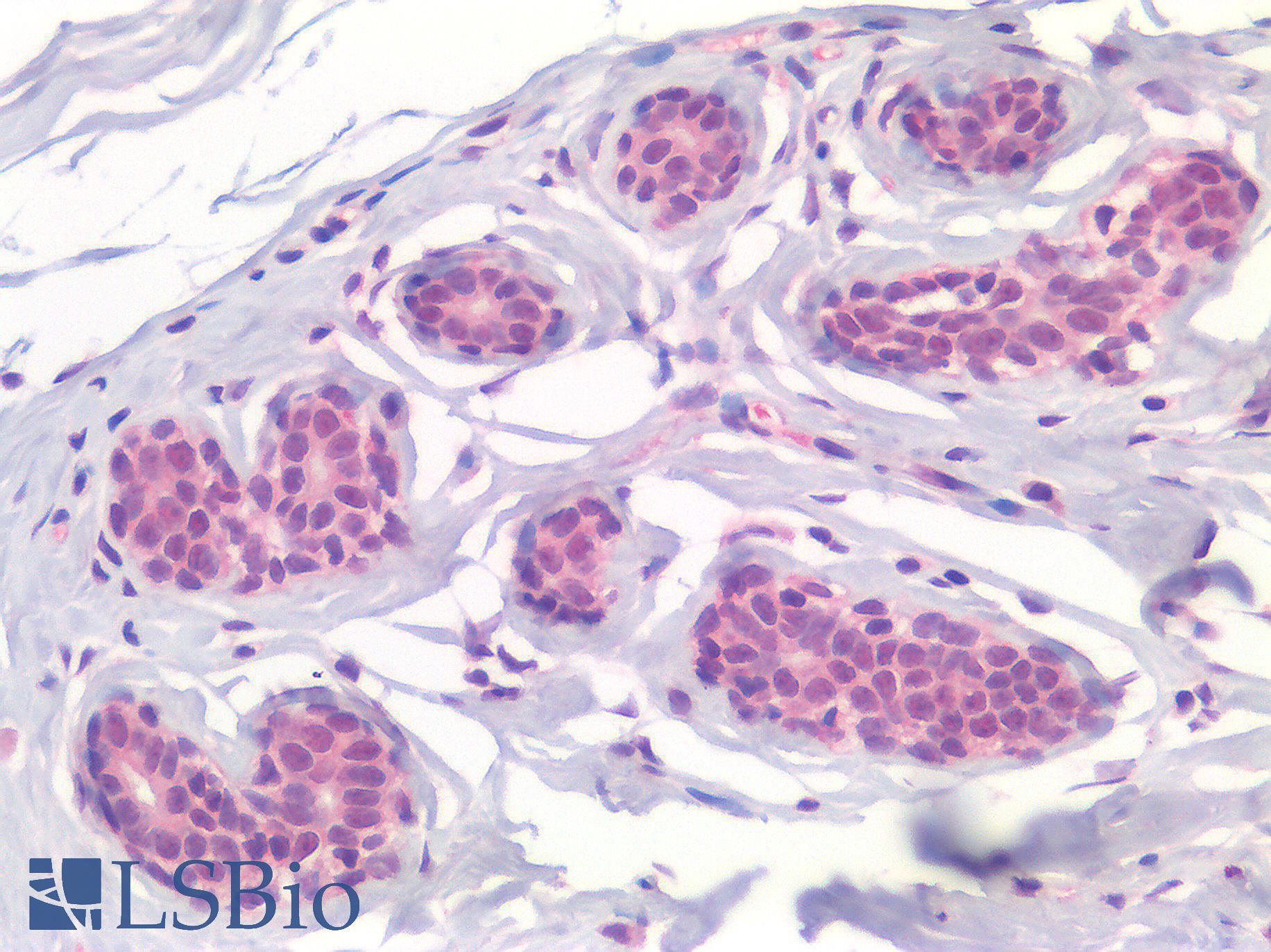 p14ARF / CDKN2A Antibody - Human Breast: Formalin-Fixed, Paraffin-Embedded (FFPE)
