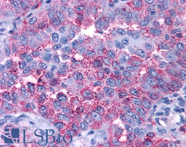 P2RY4 / P2Y4 Antibody - Anti-P2RY4 / P2Y4 antibody IHC of human Lung, Non-Small Cell Carcinoma. Immunohistochemistry of formalin-fixed, paraffin-embedded tissue after heat-induced antigen retrieval.