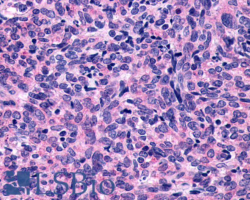 P2Y10 / P2RY10 Antibody - Anti-P2Y10 / P2RY10 antibody IHC of human Lung, Small Cell Carcinoma. Immunohistochemistry of formalin-fixed, paraffin-embedded tissue after heat-induced antigen retrieval.