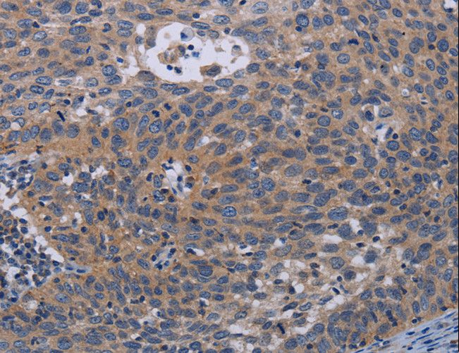 PAPPA / PAPP-A Antibody - Immunohistochemistry of paraffin-embedded Human cervical cancer using PAPPA Polyclonal Antibody at dilution of 1:50.