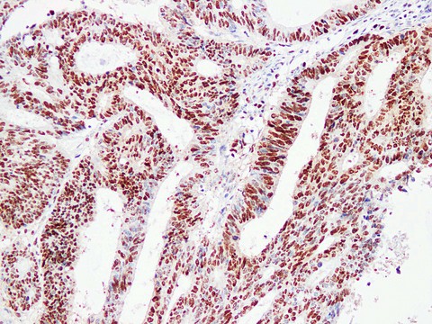 PCNA Antibody - Colon Carcinoma