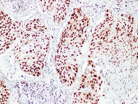 PCNA Antibody - Squamous Cell Lung Carcinoma