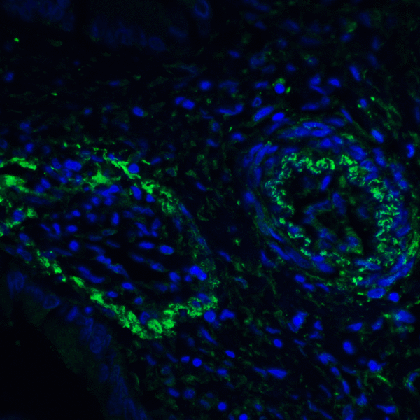PD-L2 / PDCD1LG2 / CD273 Antibody - Immunofluorescence of PD-L2 in human colon carcinoma tissue with PD-L2 antibody at 20 ug/mL. Green: PDL2 Antibody [4E10] Blue: DAPI staining