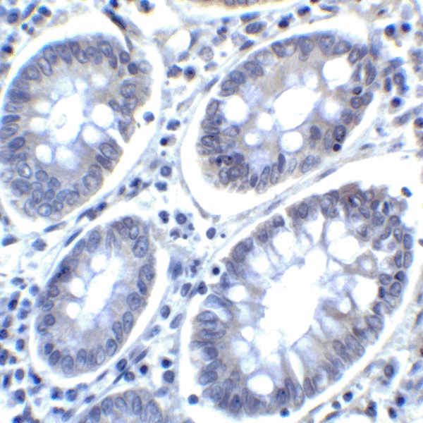 PD-L2 / PDCD1LG2 / CD273 Antibody - Immunohistochemistry of PD-L2 in human colon carcinoma tissue with PD-L2 antibody at 2 ug/mL.