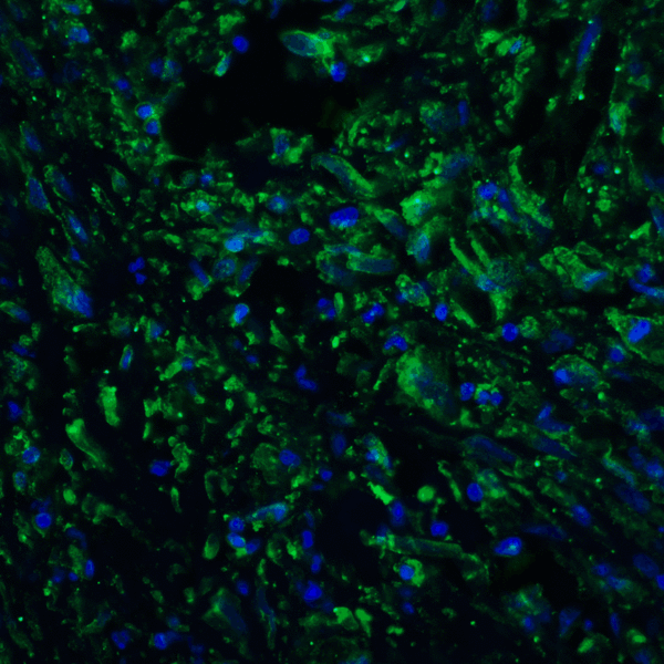 PD-L2 / PDCD1LG2 / CD273 Antibody - Immunofluorescence of PD-L2 in human colon carcinoma tissue with PD-L2 antibody at 20 ug/mL. Green: PDL2 Antibody [7C7] Blue: DAPI staining