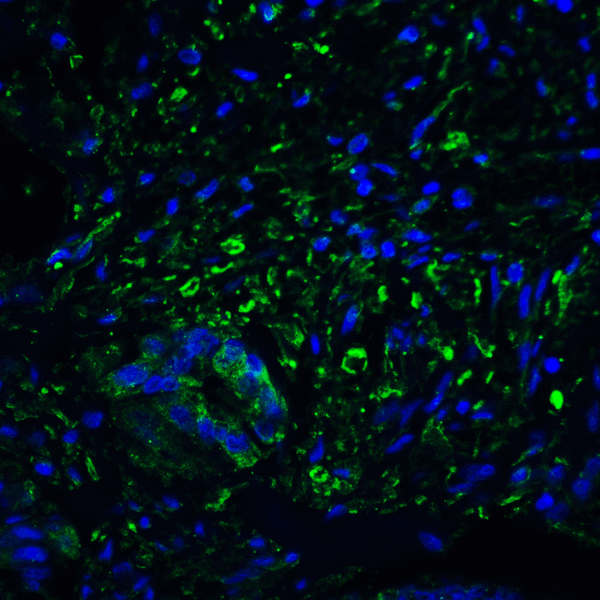 PD-L2 / PDCD1LG2 / CD273 Antibody - Immunofluorescence of PD-L2 in human colon carcinoma tissue with PD-L2 antibody at 20 ug/mL. Green: PDL2 Antibody [8C12] Blue: DAPI staining