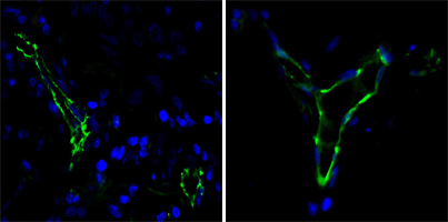 PECAM-1 / CD31 Antibody - Immunofluorescence of paraffin-embedded human lung cancer(left) and breast cancer(right) cells using CD31 mouse monoclonal antibody (green). Blue: DRAQ5 fluorescent DNA dye.