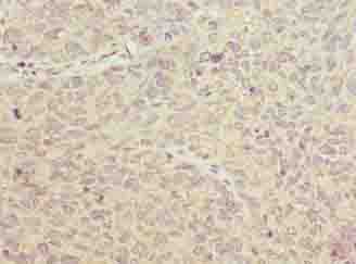 PGM2L1 Antibody - Immunohistochemistry of paraffin-embedded human cervical cancer using antibody at dilution of 1:100.