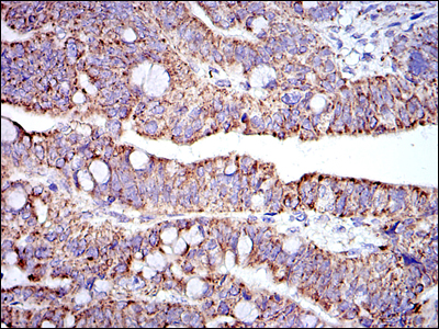 PHB / Prohibitin Antibody - IHC of paraffin-embedded rectum cancer tissues using PHB mouse monoclonal antibody with DAB staining.