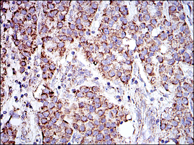 PHB / Prohibitin Antibody - IHC of paraffin-embedded liver cancer tissues using PHB mouse monoclonal antibody with DAB staining.