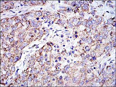 PHB / Prohibitin Antibody - IHC of paraffin-embedded lung cancer tissues using PHB mouse monoclonal antibody with DAB staining.