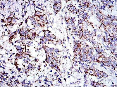 PHB / Prohibitin Antibody - IHC of paraffin-embedded stomach cancer tissues using PHB mouse monoclonal antibody with DAB staining.