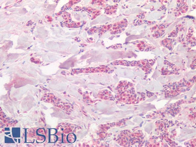 PIK3CA / PI3K Alpha Antibody - Human Breast Carcinoma: Formalin-Fixed, Paraffin-Embedded (FFPE)