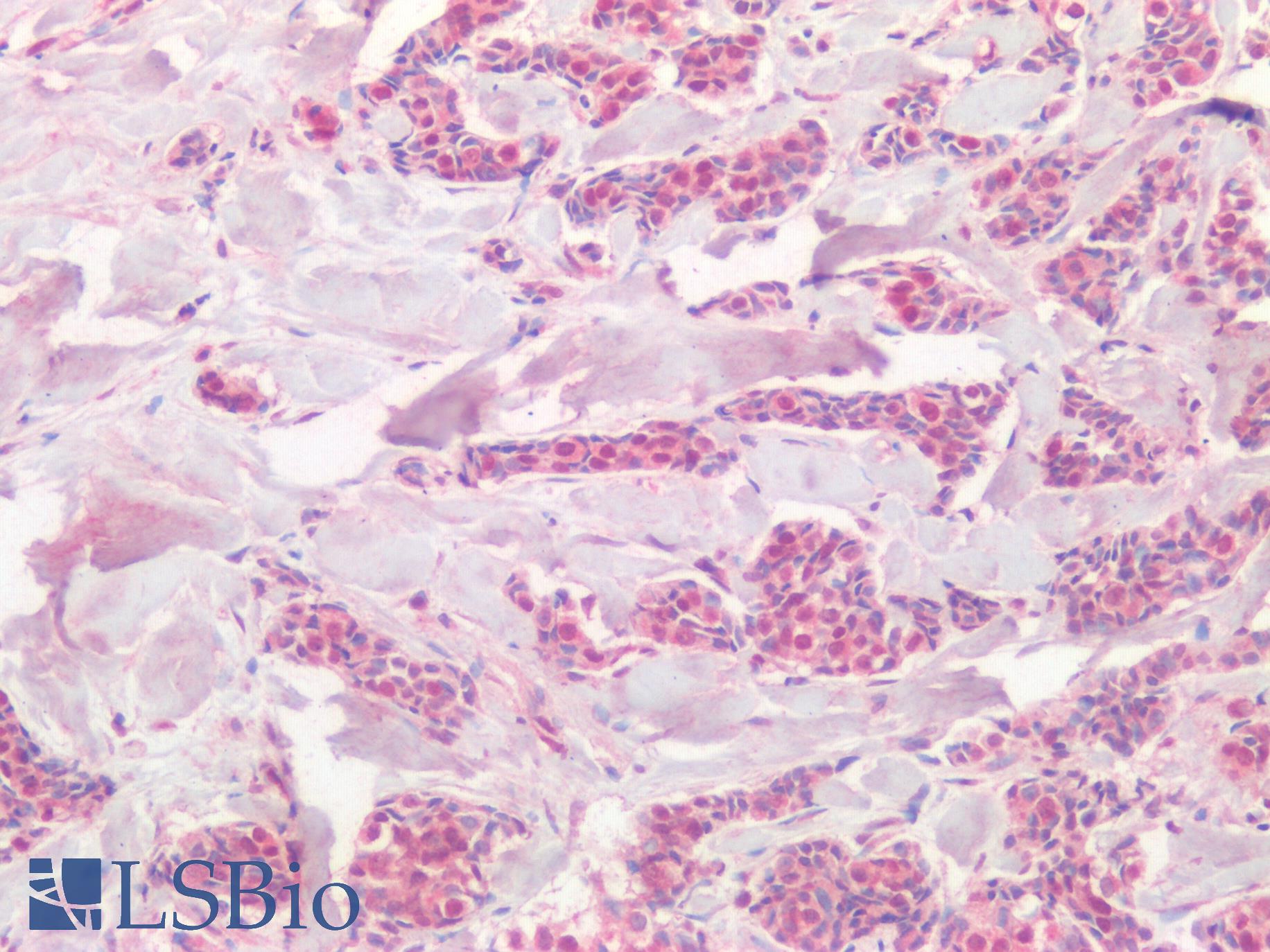 PIK3CA / PI3K Alpha Antibody - Human Breast Carcinoma: Formalin-Fixed, Paraffin-Embedded (FFPE)