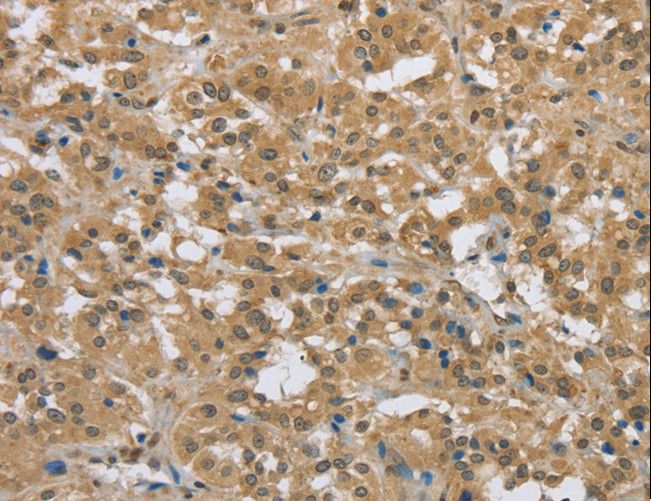 PKD1 / Polycystin Antibody - Immunohistochemistry of paraffin-embedded Human breast cancer using PKD1 Polyclonal Antibody at dilution of 1:50.