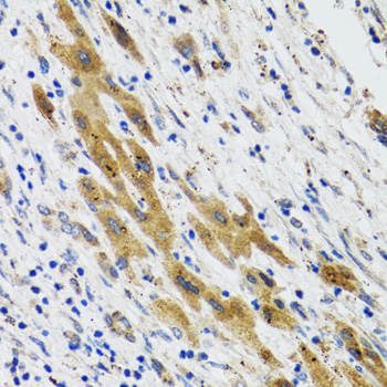 PLA2G2D Antibody - Immunohistochemistry of paraffin-embedded human liver cancer tissue.