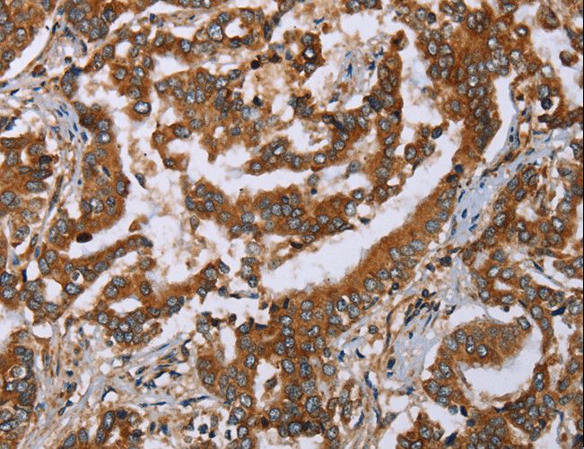 PLXNB1 / Plexin-B1 Antibody - Immunohistochemistry of paraffin-embedded Human breast cancer using PLXNB1 Polyclonal Antibody at dilution of 1:50.